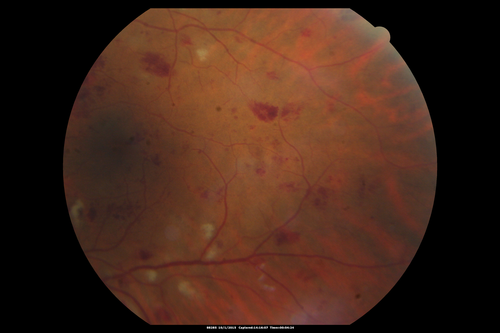Hairy Cell Leukemia - Retinal Hemorrhage and twig Branch Vein Occlusion
79 year old man He has had hairy cell leukemia since 2002.  He is in remission.  His last blood tests were 9/2018.  He just moved down here and needs a new leukemia doctor.  His vision is fine. 
VA OD: Dcc20/25
VA OS: Dcc20/25
IOP: TP: OD:12 OS:12
