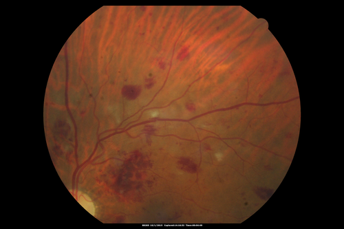 Hairy Cell Leukemia - Retinal Hemorrhage and twig Branch Vein Occlusion
79 year old man He has had hairy cell leukemia since 2002.  He is in remission.  His last blood tests were 9/2018.  He just moved down here and needs a new leukemia doctor.  His vision is fine. 
VA OD: Dcc20/25
VA OS: Dcc20/25
IOP: TP: OD:12 OS:12
