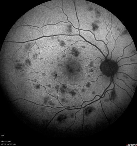 Hairy Cell Leukemia - Retinal Hemorrhage and twig Branch Vein Occlusion
79 year old man He has had hairy cell leukemia since 2002.  He is in remission.  His last blood tests were 9/2018.  He just moved down here and needs a new leukemia doctor.  His vision is fine. 
VA OD: Dcc20/25
VA OS: Dcc20/25
IOP: TP: OD:12 OS:12
