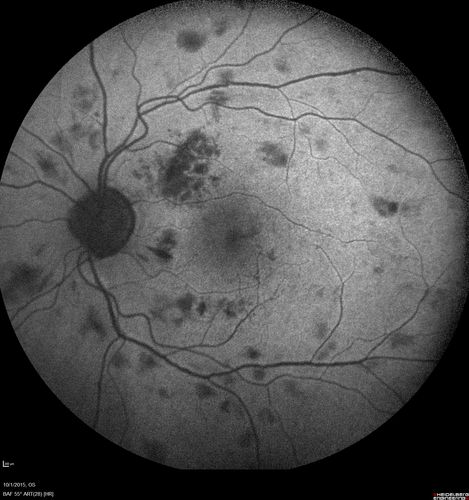 Hairy Cell Leukemia - Retinal Hemorrhage and twig Branch Vein Occlusion
79 year old man He has had hairy cell leukemia since 2002.  He is in remission.  His last blood tests were 9/2018.  He just moved down here and needs a new leukemia doctor.  His vision is fine. 
VA OD: Dcc20/25
VA OS: Dcc20/25
IOP: TP: OD:12 OS:12
