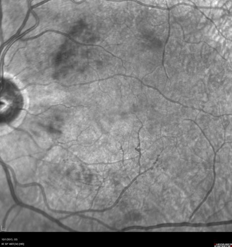 Hairy Cell Leukemia - Retinal Hemorrhage and twig Branch Vein Occlusion
79 year old man He has had hairy cell leukemia since 2002.  He is in remission.  His last blood tests were 9/2018.  He just moved down here and needs a new leukemia doctor.  His vision is fine. 
VA OD: Dcc20/25
VA OS: Dcc20/25
IOP: TP: OD:12 OS:12
