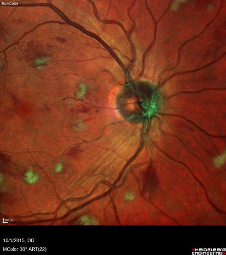 Hairy Cell Leukemia - Retinal Hemorrhage and twig Branch Vein Occlusion
79 year old man He has had hairy cell leukemia since 2002.  He is in remission.  His last blood tests were 9/2018.  He just moved down here and needs a new leukemia doctor.  His vision is fine. 
VA OD: Dcc20/25
VA OS: Dcc20/25
IOP: TP: OD:12 OS:12
