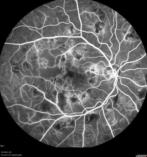Hairy Cell Leukemia - Retinal Hemorrhage and twig Branch Vein Occlusion
79 year old man He has had hairy cell leukemia since 2002.  He is in remission.  His last blood tests were 9/2018.  He just moved down here and needs a new leukemia doctor.  His vision is fine. 
VA OD: Dcc20/25
VA OS: Dcc20/25
IOP: TP: OD:12 OS:12

