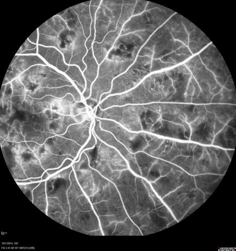 Hairy Cell Leukemia - Retinal Hemorrhage and twig Branch Vein Occlusion
79 year old man He has had hairy cell leukemia since 2002.  He is in remission.  His last blood tests were 9/2018.  He just moved down here and needs a new leukemia doctor.  His vision is fine. 
VA OD: Dcc20/25
VA OS: Dcc20/25
IOP: TP: OD:12 OS:12
