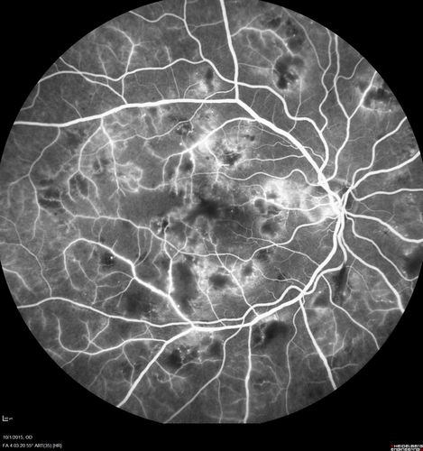 Hairy Cell Leukemia - Retinal Hemorrhage and twig Branch Vein Occlusion
79 year old man He has had hairy cell leukemia since 2002.  He is in remission.  His last blood tests were 9/2018.  He just moved down here and needs a new leukemia doctor.  His vision is fine. 
VA OD: Dcc20/25
VA OS: Dcc20/25
IOP: TP: OD:12 OS:12
