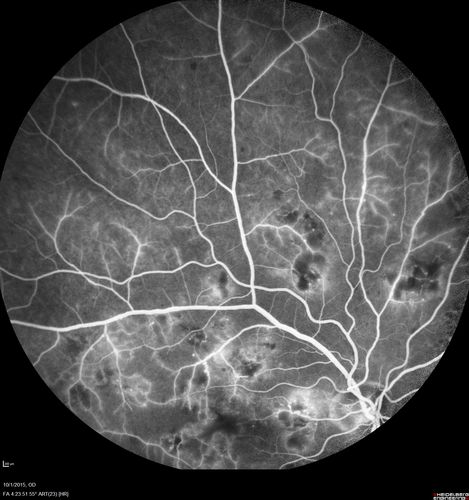 Hairy Cell Leukemia - Retinal Hemorrhage and twig Branch Vein Occlusion
79 year old man He has had hairy cell leukemia since 2002.  He is in remission.  His last blood tests were 9/2018.  He just moved down here and needs a new leukemia doctor.  His vision is fine. 
VA OD: Dcc20/25
VA OS: Dcc20/25
IOP: TP: OD:12 OS:12
