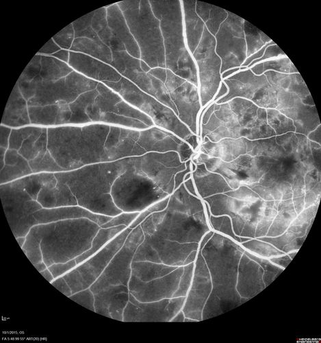 Hairy Cell Leukemia - Retinal Hemorrhage and twig Branch Vein Occlusion
79 year old man He has had hairy cell leukemia since 2002.  He is in remission.  His last blood tests were 9/2018.  He just moved down here and needs a new leukemia doctor.  His vision is fine. 
VA OD: Dcc20/25
VA OS: Dcc20/25
IOP: TP: OD:12 OS:12
