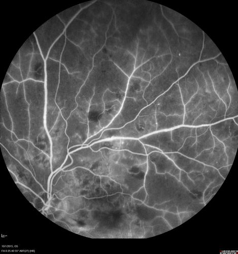 Hairy Cell Leukemia - Retinal Hemorrhage and twig Branch Vein Occlusion
79 year old man He has had hairy cell leukemia since 2002.  He is in remission.  His last blood tests were 9/2018.  He just moved down here and needs a new leukemia doctor.  His vision is fine. 
VA OD: Dcc20/25
VA OS: Dcc20/25
IOP: TP: OD:12 OS:12
