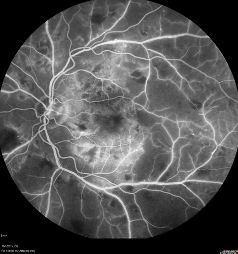 Hairy Cell Leukemia - Retinal Hemorrhage and twig Branch Vein Occlusion
79 year old man He has had hairy cell leukemia since 2002.  He is in remission.  His last blood tests were 9/2018.  He just moved down here and needs a new leukemia doctor.  His vision is fine. 
VA OD: Dcc20/25
VA OS: Dcc20/25
IOP: TP: OD:12 OS:12
