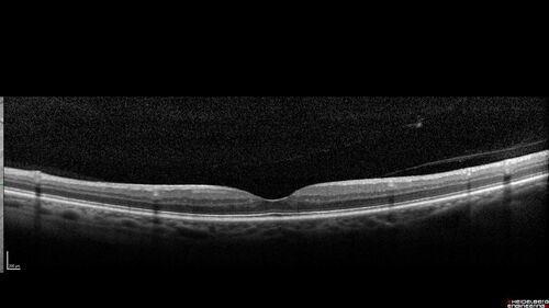 hairycellleukemia_wikre_070519_05.jpg