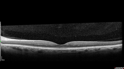 hairycellleukemia_wikre_070519_06.jpg
