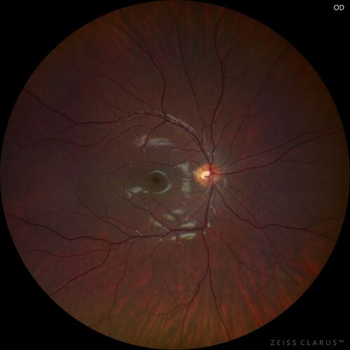 Combined hamartoma of the retina and retinal pigment epithelium
8 year old boy failed vision screening at school.  VA 20/20 OD, 20/40 OS
