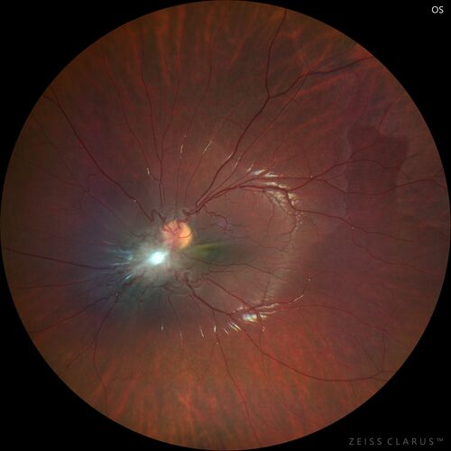 Combined hamartoma of the retina and retinal pigment epithelium
8 year old boy failed vision screening at school.  VA 20/20 OD, 20/40 OS
