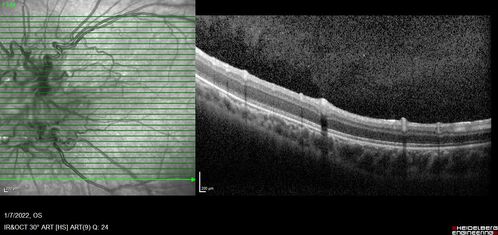 Combined hamartoma of the retina and retinal pigment epithelium
8 year old boy failed vision screening at school.  VA 20/20 OD, 20/40 OS
