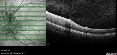 Combined hamartoma of the retina and retinal pigment epithelium
8 year old boy failed vision screening at school.  VA 20/20 OD, 20/40 OS
