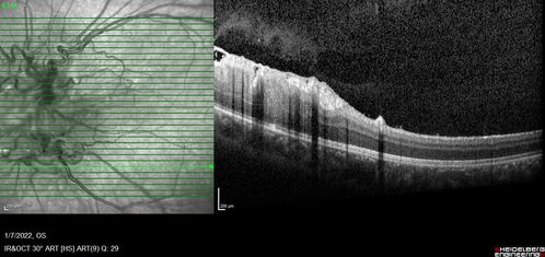 Combined hamartoma of the retina and retinal pigment epithelium
8 year old boy failed vision screening at school.  VA 20/20 OD, 20/40 OS
