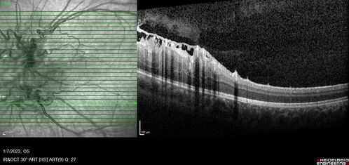Combined hamartoma of the retina and retinal pigment epithelium
8 year old boy failed vision screening at school.  VA 20/20 OD, 20/40 OS
