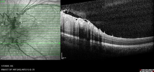 Combined hamartoma of the retina and retinal pigment epithelium
8 year old boy failed vision screening at school.  VA 20/20 OD, 20/40 OS

