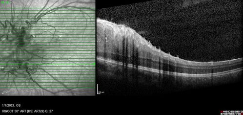 Combined hamartoma of the retina and retinal pigment epithelium
8 year old boy failed vision screening at school.  VA 20/20 OD, 20/40 OS
