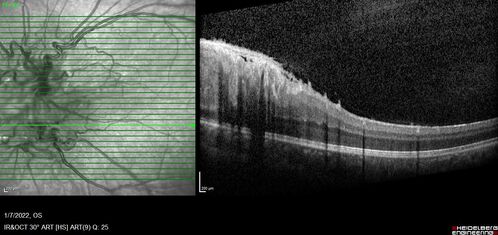 Combined hamartoma of the retina and retinal pigment epithelium
8 year old boy failed vision screening at school.  VA 20/20 OD, 20/40 OS
