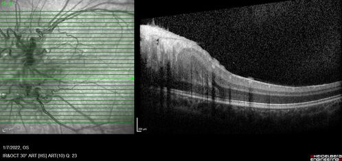 Combined hamartoma of the retina and retinal pigment epithelium
8 year old boy failed vision screening at school.  VA 20/20 OD, 20/40 OS
