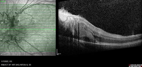Combined hamartoma of the retina and retinal pigment epithelium
8 year old boy failed vision screening at school.  VA 20/20 OD, 20/40 OS
