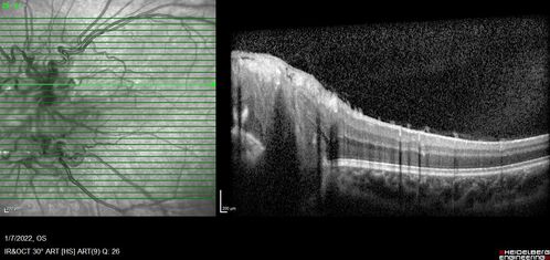 Combined hamartoma of the retina and retinal pigment epithelium
8 year old boy failed vision screening at school.  VA 20/20 OD, 20/40 OS
