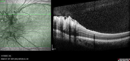 Combined hamartoma of the retina and retinal pigment epithelium
8 year old boy failed vision screening at school.  VA 20/20 OD, 20/40 OS
