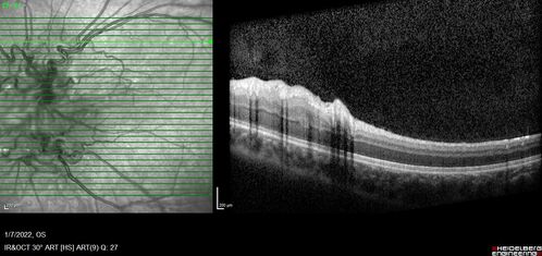 Combined hamartoma of the retina and retinal pigment epithelium
8 year old boy failed vision screening at school.  VA 20/20 OD, 20/40 OS
