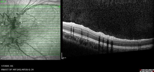 Combined hamartoma of the retina and retinal pigment epithelium
8 year old boy failed vision screening at school.  VA 20/20 OD, 20/40 OS
