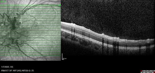Combined hamartoma of the retina and retinal pigment epithelium
8 year old boy failed vision screening at school.  VA 20/20 OD, 20/40 OS
