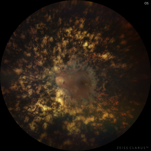 Heavy Panretinal Photocoagulation for Proliferative Diabetic Retinopathy about 40 years ago
64 year old female - images from 2018 - heavy PRP about 30 years ago 
VA 20/20 OD, 20/50 OS
