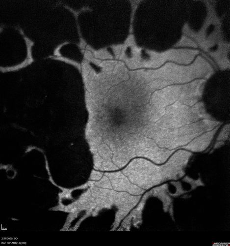 Heavy Panretinal Photocoagulation for Proliferative Diabetic Retinopathy about 40 years ago
64 year old female - images from 2018 - heavy PRP about 30 years ago 
VA 20/20 OD, 20/50 OS
