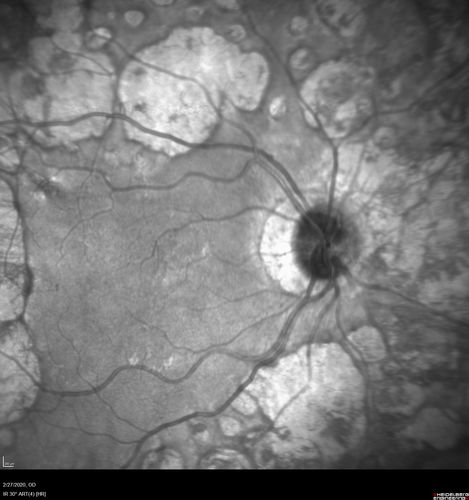 Heavy Panretinal Photocoagulation for Proliferative Diabetic Retinopathy about 40 years ago
64 year old female - images from 2018 - heavy PRP about 30 years ago 
VA 20/20 OD, 20/50 OS
