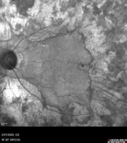 Heavy Panretinal Photocoagulation for Proliferative Diabetic Retinopathy about 40 years ago
64 year old female - images from 2018 - heavy PRP about 30 years ago 
VA 20/20 OD, 20/50 OS
