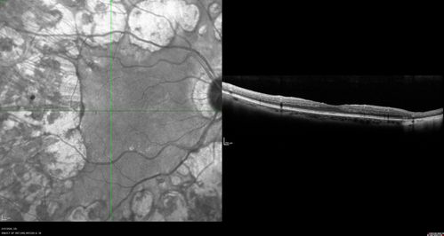 Heavy Panretinal Photocoagulation for Proliferative Diabetic Retinopathy about 40 years ago
64 year old female - images from 2018 - heavy PRP about 30 years ago 
VA 20/20 OD, 20/50 OS
