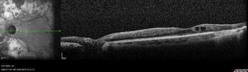 Heavy Panretinal Photocoagulation for Proliferative Diabetic Retinopathy about 40 years ago
64 year old female - images from 2018 - heavy PRP about 30 years ago 
VA 20/20 OD, 20/50 OS
