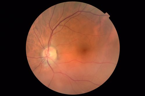 Hemangioma OS with good vison - 01-29-18
Images 7 years following initial uploaded images
