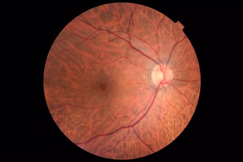 Hemangioma OS with good vison - 01-29-18
Images 7 years following initial uploaded images
