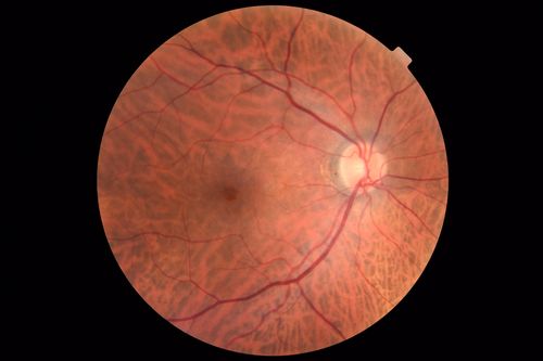 Hemangioma OS with good vison - 01-29-18
Images 7 years following initial uploaded images
