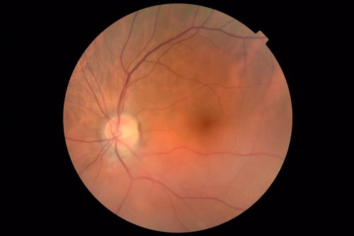Hemangioma OS with good vison - 01-29-18
Images 7 years following initial uploaded images
