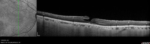 Hemangioma OS with good vison - 01-29-18
Images 7 years following initial uploaded images

