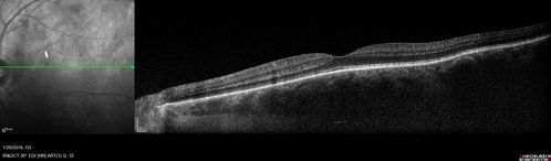 Hemangioma OS with good vison - 01-29-18
Images 7 years following initial uploaded images

