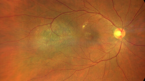 Choroidal Hemangioma Requiring PDT repeatedly
64 year old man.  Diagnosed with hemangioma in 2015.  PDT in 2016.  Images are from 2020 when fluid started to reaccumulate.  Needed PDT repeated two more times.
PDT treatments: [1] 2/19/2015 -Â  Pavan (IOPÂ  problem after PDT)Â  AND [2] 11/2/21 PDT (7 mm temporal to fovea) - SMCÂ  AND [3] 7/22/22 PDT 7.5 mm Temporal to the fovea
