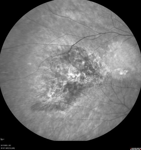 Choroidal Hemangioma Requiring PDT repeatedly
64 year old man.  Diagnosed with hemangioma in 2015.  PDT in 2016.  Images are from 2020 when fluid started to reaccumulate.  Needed PDT repeated two more times.
PDT treatments: [1] 2/19/2015 -Â  Pavan (IOPÂ  problem after PDT)Â  AND [2] 11/2/21 PDT (7 mm temporal to fovea) - SMCÂ  AND [3] 7/22/22 PDT 7.5 mm Temporal to the fovea
