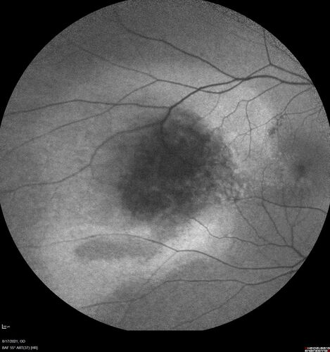 Choroidal Hemangioma Requiring PDT repeatedly
64 year old man.  Diagnosed with hemangioma in 2015.  PDT in 2016.  Images are from 2020 when fluid started to reaccumulate.  Needed PDT repeated two more times.
PDT treatments: [1] 2/19/2015 -Â  Pavan (IOPÂ  problem after PDT)Â  AND [2] 11/2/21 PDT (7 mm temporal to fovea) - SMCÂ  AND [3] 7/22/22 PDT 7.5 mm Temporal to the fovea
