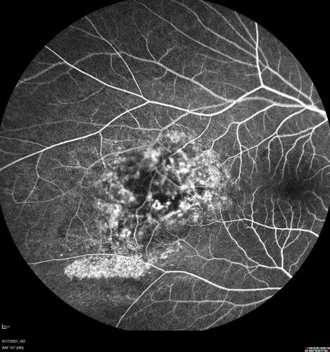 Choroidal Hemangioma Requiring PDT repeatedly
64 year old man.  Diagnosed with hemangioma in 2015.  PDT in 2016.  Images are from 2020 when fluid started to reaccumulate.  Needed PDT repeated two more times.
PDT treatments: [1] 2/19/2015 -Â  Pavan (IOPÂ  problem after PDT)Â  AND [2] 11/2/21 PDT (7 mm temporal to fovea) - SMCÂ  AND [3] 7/22/22 PDT 7.5 mm Temporal to the fovea
