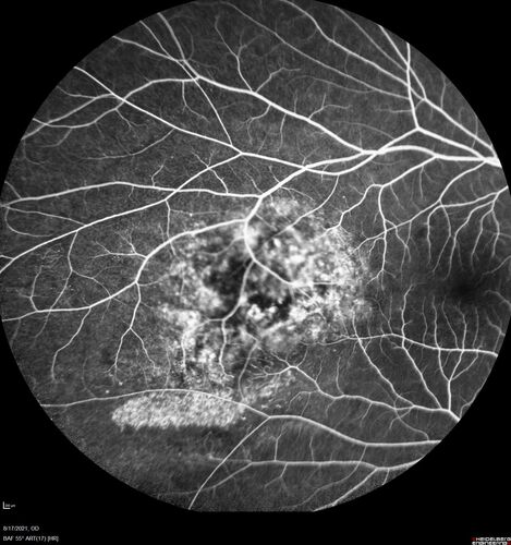 Choroidal Hemangioma Requiring PDT repeatedly
64 year old man.  Diagnosed with hemangioma in 2015.  PDT in 2016.  Images are from 2020 when fluid started to reaccumulate.  Needed PDT repeated two more times.
PDT treatments: [1] 2/19/2015 -Â  Pavan (IOPÂ  problem after PDT)Â  AND [2] 11/2/21 PDT (7 mm temporal to fovea) - SMCÂ  AND [3] 7/22/22 PDT 7.5 mm Temporal to the fovea
