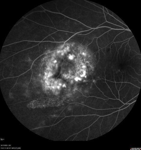 Choroidal Hemangioma Requiring PDT repeatedly
64 year old man.  Diagnosed with hemangioma in 2015.  PDT in 2016.  Images are from 2020 when fluid started to reaccumulate.  Needed PDT repeated two more times.
PDT treatments: [1] 2/19/2015 -Â  Pavan (IOPÂ  problem after PDT)Â  AND [2] 11/2/21 PDT (7 mm temporal to fovea) - SMCÂ  AND [3] 7/22/22 PDT 7.5 mm Temporal to the fovea
