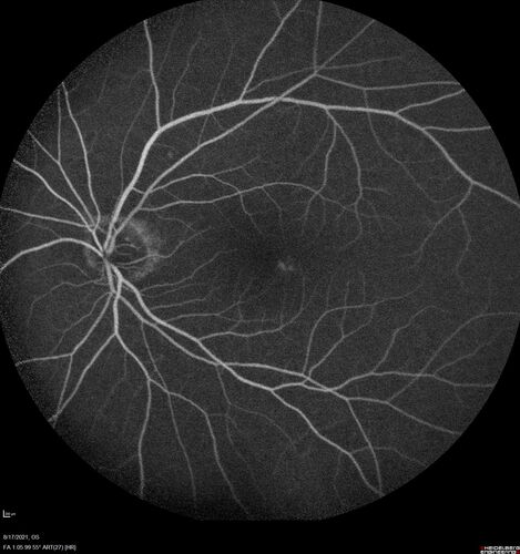 Choroidal Hemangioma Requiring PDT repeatedly
64 year old man.  Diagnosed with hemangioma in 2015.  PDT in 2016.  Images are from 2020 when fluid started to reaccumulate.  Needed PDT repeated two more times.
PDT treatments: [1] 2/19/2015 -Â  Pavan (IOPÂ  problem after PDT)Â  AND [2] 11/2/21 PDT (7 mm temporal to fovea) - SMCÂ  AND [3] 7/22/22 PDT 7.5 mm Temporal to the fovea
